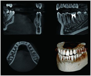 歯科用CT